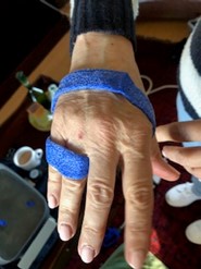 A wounded hand strapped in a nerve glides, used for the treatment of nerve injuries and re-education.